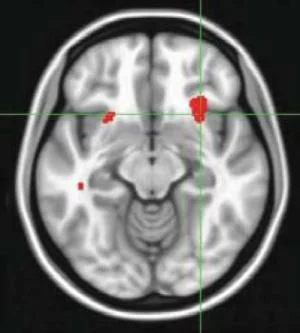 Scan Predicts Whether Therapy or Meds Will Best Lift Depression