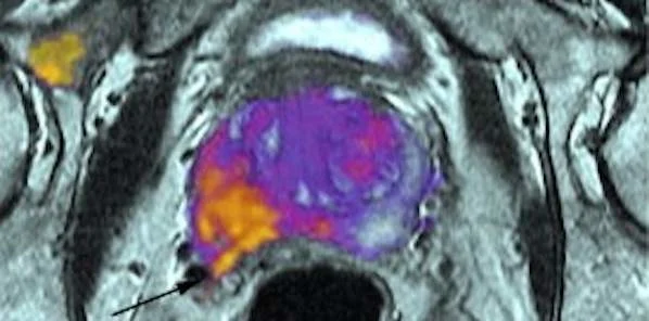 RSI-MRI Detects Spread of Cancer Beyond Prostate