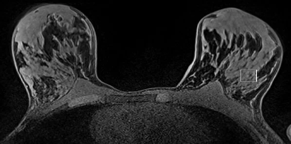 MR Spectroscopy for BRCA Gene