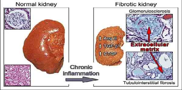 New Therapeutic Strategy for CKD