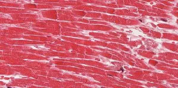 Heart Muscle Inflammation Peaks Twice after MI