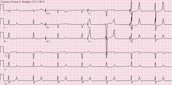 Zirconium Cyclosilicate Effective For Hyperkalaemia 