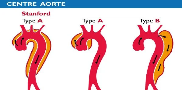 Improved Survival Rates in Aortic Dissection