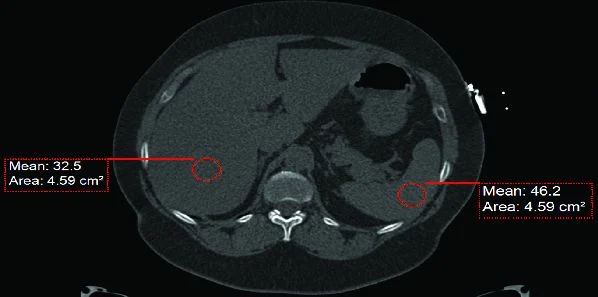 Coronary Artery Plaque Associated with Liver Disease