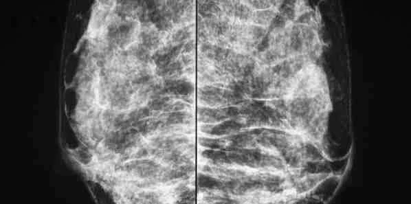 Combining Tomosynthesis and Mammography is Cost-Effective