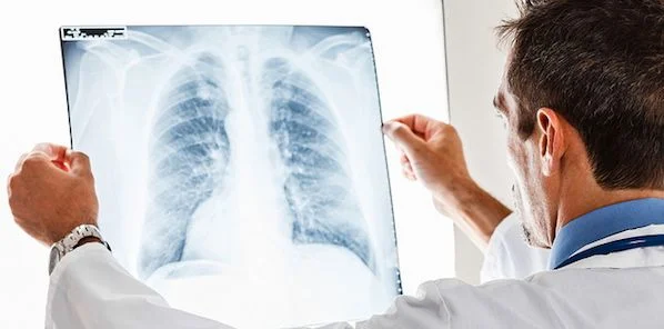 Low-Dose CT Beats X-Ray in Lung Cancer Detection