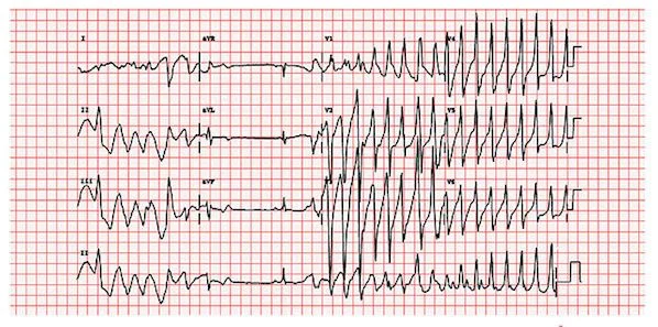 ESC 2014: Expert Consensus on Ventricular Arrhythmias