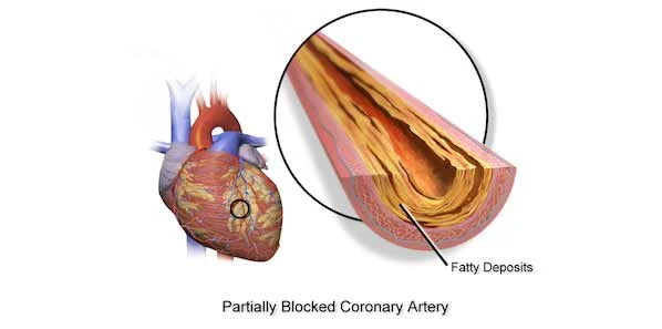 Severe Calcification Ups Risk of Cardiovascular Event