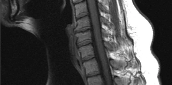 MRI in Cervical Spine Clearance