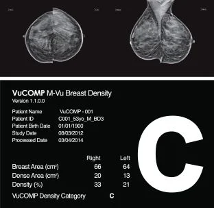 VuCOMP&#039;s M-Vu Breast Density Cleared for Canada 