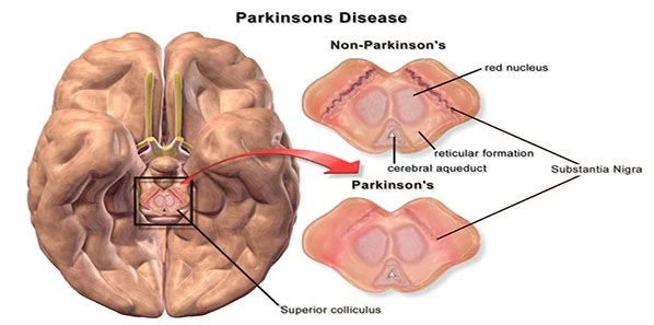 Mapping Technique for Modulation Following Sham Surgery