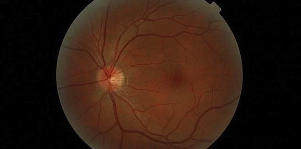 Noninvasive Retinal Imaging Tool For  Alzheimer&#039;s Detection