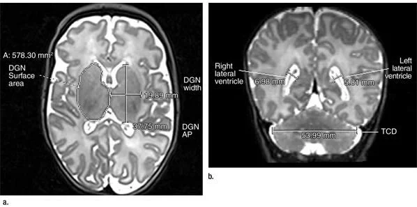 MRI Detects Late Preterm Infant Brain Abnormalities