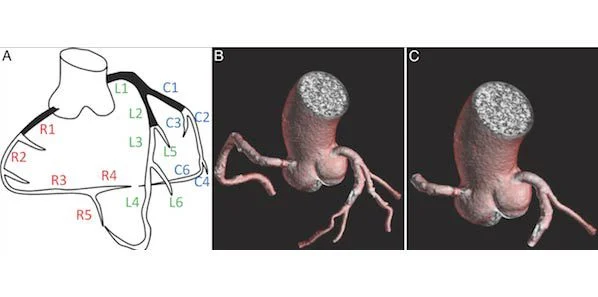 Study: CT Offers Measurement Tool for Arterial Plaque in Diabetic Patients