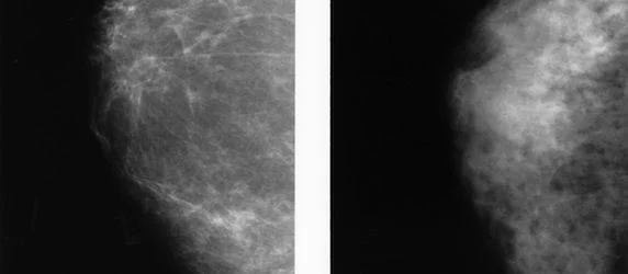 ECR 2014: Volpara Solutions Launches Two Quantitative Breast Imaging Tools 