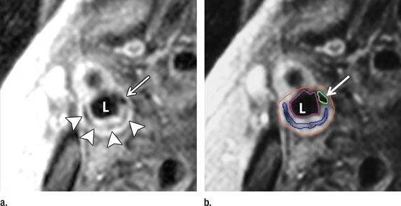 Carotid Artery MRI Predicts Strokes and Heart Attacks 