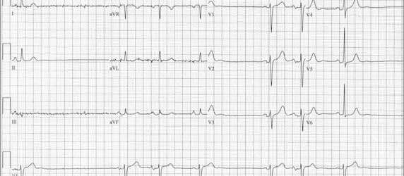 Delayed Enhancement MRI Useful For Determining Arrhythmia Treatment 