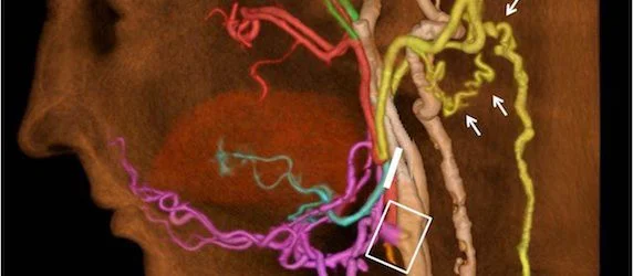 RSNA 2013: New Blood Vessels Network Emerges Post Face Transplantation Surgery