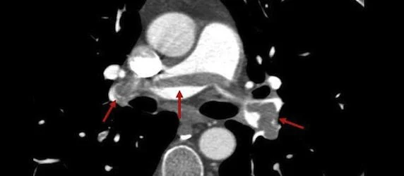 Has CT Scanning Caused Overdiagnosis of Pulmonary Emboli? 