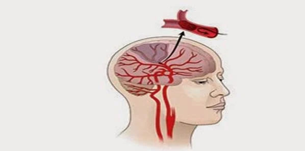 Stroke Patients Receiving Timely Care