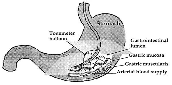 Assessing the Effectiveness of Gastric Tonometry Guided Therapy