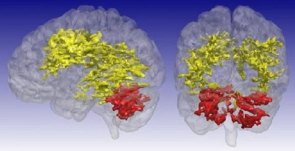 Bipolar Disorder: New MRI Method Provides New Insights