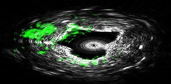 High-Speed Imaging for Cardiovascular Disease Diagnosis