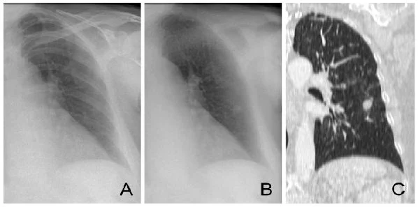 Bone Suppression Optimises Chest X-ray&#039;s IPA Diagnosis