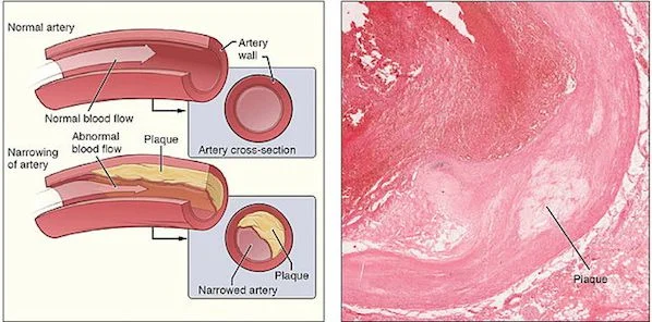 Imaging IDs People at Risk for Stroke