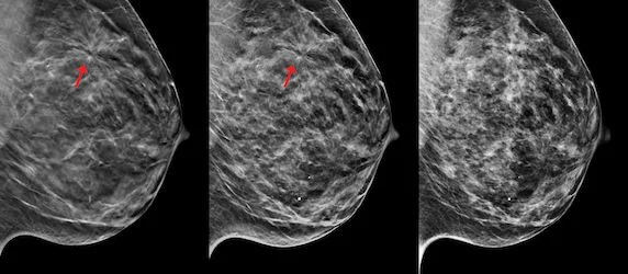 3D Mammography Named &lsquo;Hottest Clinical Procedure&rsquo; For The Fourth Consecutive Year