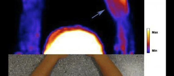 PET Scan Illuminates Tennis Elbow Pain Processes