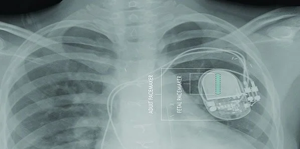 First Fully Implantable Micropacemaker for Foetal Use