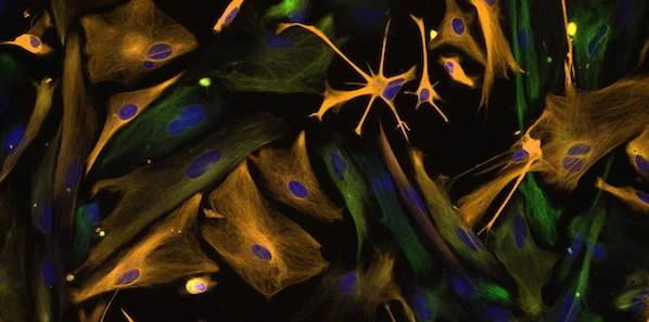 Gene Interaction Discovery Could Lead to New Brain Cancer Therapies