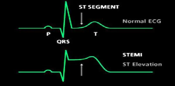 In-Hospital Heart Attack: Higher Risk of Death? 