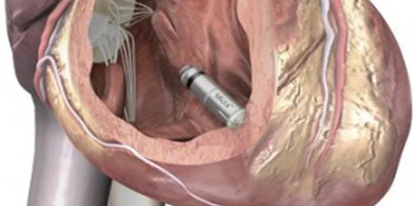 Leadless Pacemaker: Promising Potential