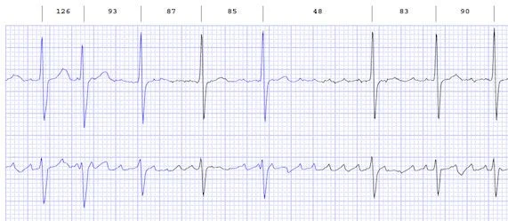 New Atrial Fibrillation Treatment Device