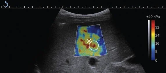 New Aixplorer Ultrasound System Allows For Non-Invasive Liver Fibrosis Measurement