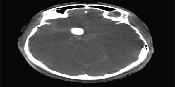 RSNA 2014: Siemens Introduces New Applications For Angiography