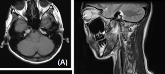 Circle Contact Lenses are Potential MRI Hazard