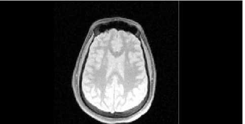 New MRI Method Fingerprints Tissues and Diseases 
