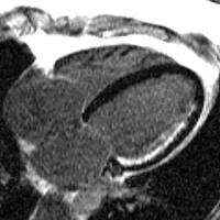 MRI Saves Heart Muscle 