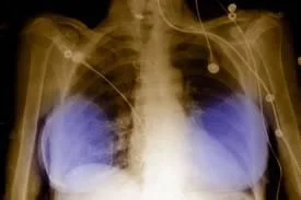breast_implants.jpg