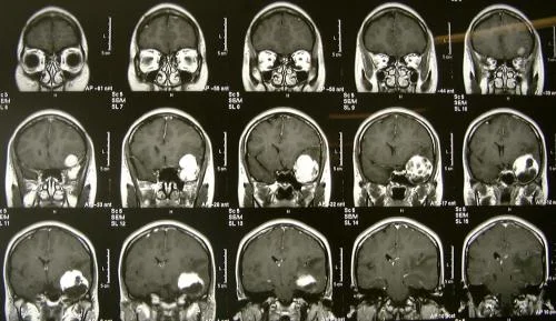 0280_Meningioma.jpg