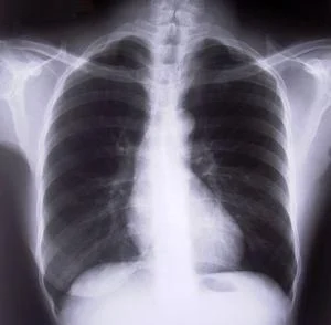 chest_xray.jpg