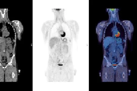 PET Scan after Chemo Could Avoid Need for Radiotherapy