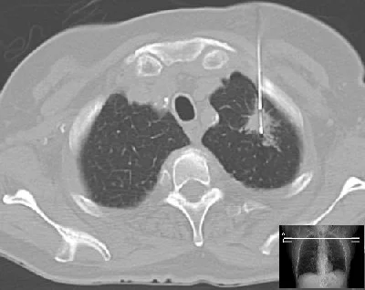 ESR/ERS New Lung Cancer Screening Recommendations