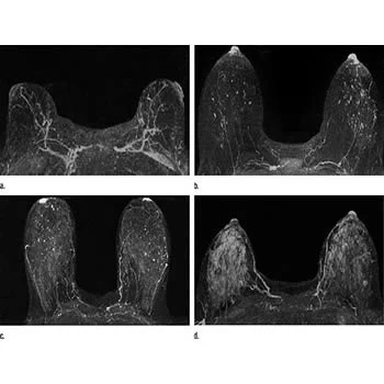 Could MRI Improve Breast Cancer Risk Prediction?