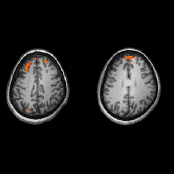 Advanced MRI Scans Could Predict Schizophrenia