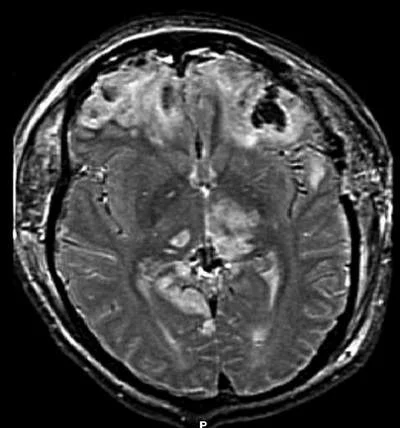 Traumatic brain injury