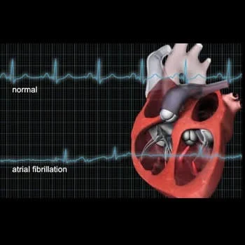 Post-Operative Atrial Fibrillation Increases Risk of Heart Attack, Stroke 